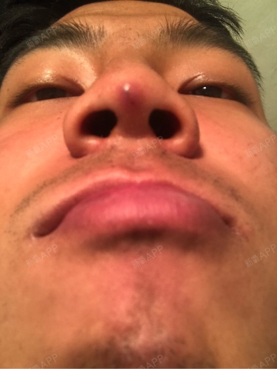 线雕隆鼻后还看得到黑色的线头.鼻头红肿.怎么办?