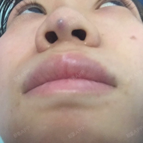 我去年十一月份做了线雕鼻,一个星期后感觉线顶着我鼻头了