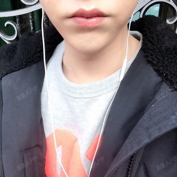 术后一个月了,前两天去医院注射了预防疤痕和增生的