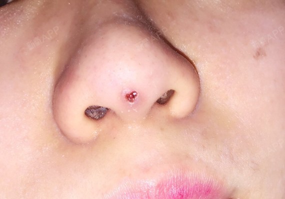 我去年十一月份做了线雕鼻,一个星期后感觉线顶着我鼻_圈子-新氧美容