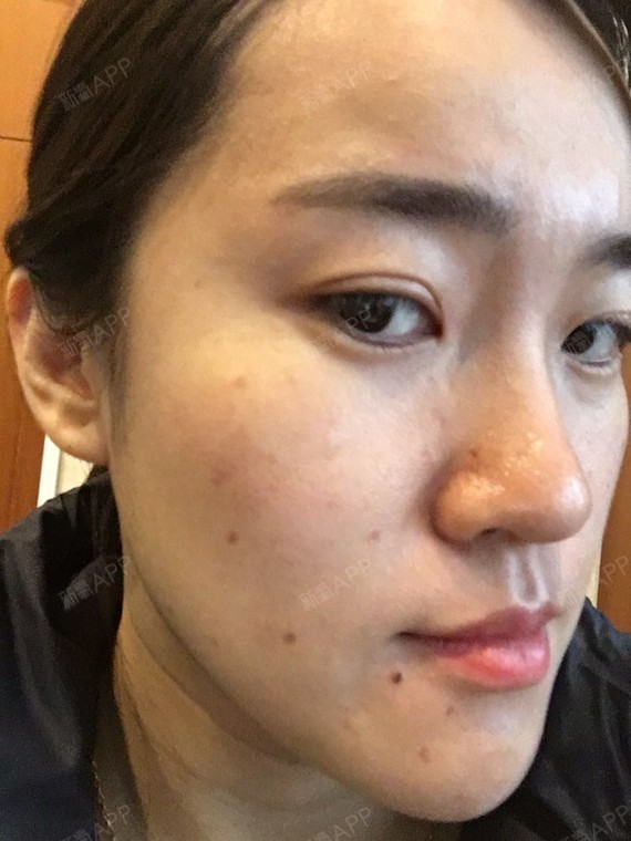 点完痣到现在快一个月了,痣变成了像痘印一样的黄褐色_圈子-新氧美容