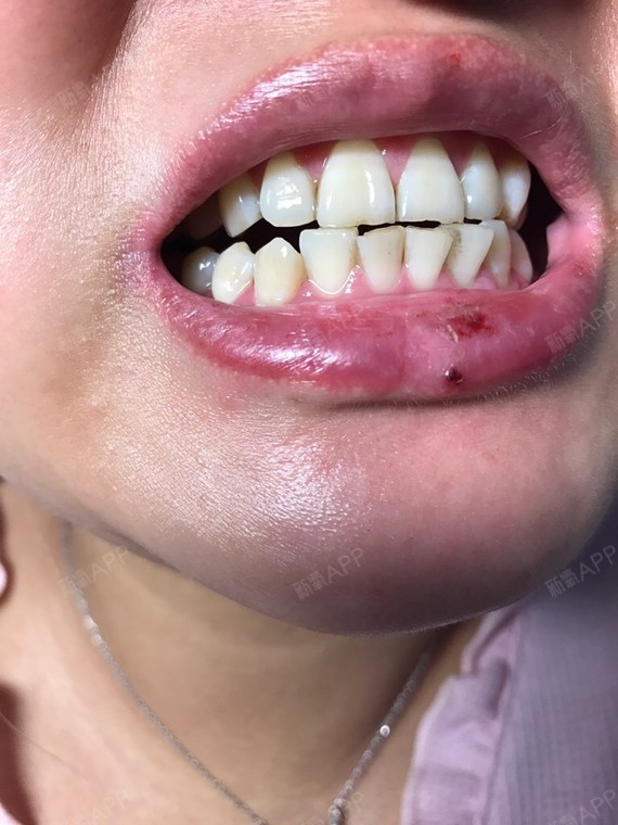 氧气ed2bc63冷光美白第1天美丽日记