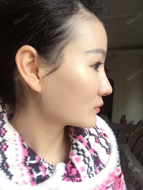 重庆膨体隆鼻好不好_效果图_氧气_beho91c02膨体隆鼻术后第16天_新氧