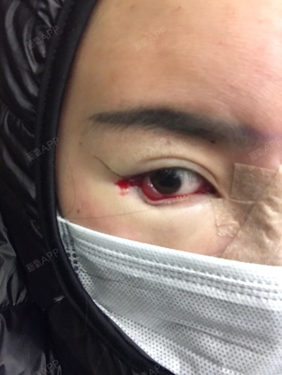 李小胖爱健身开外眼角第1天美丽日记