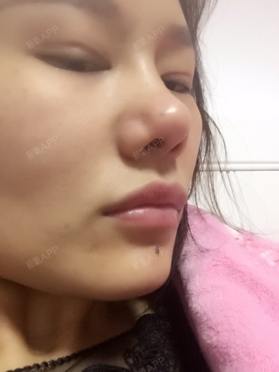 鼻子取假体鼻头增生严重,求医生做修复手术