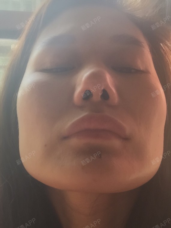 在禾丽医院做的鼻子失败,结果取假体后鼻头严重增生求_圈子-新氧美容
