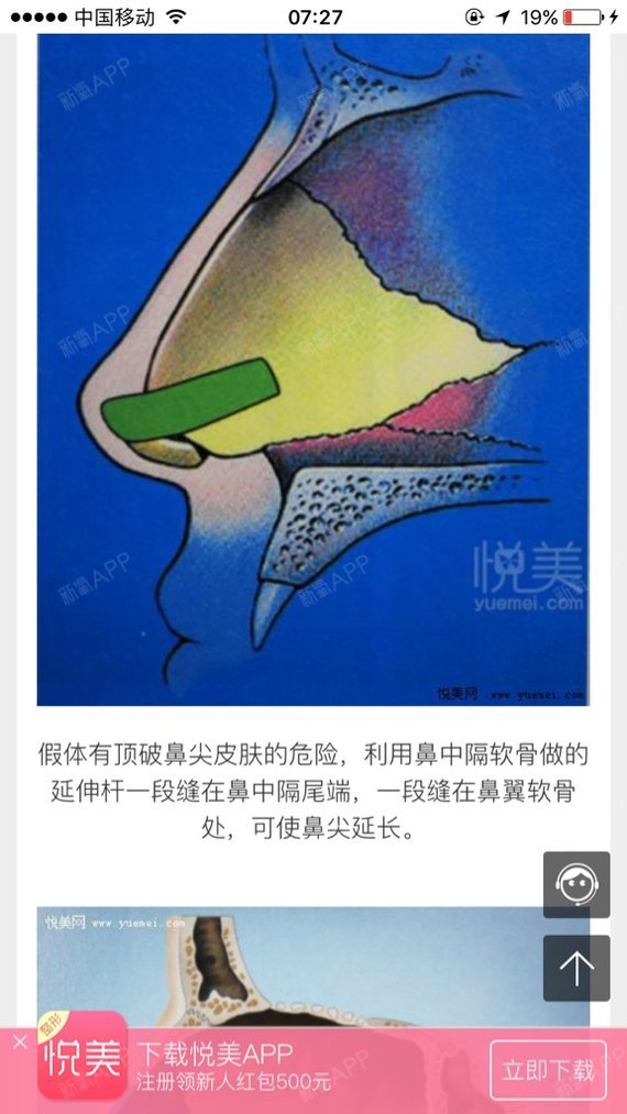 短鼻延长,鼻尖下拉延长不一定要鼻部多项全套以及鼻中隔_圈子-新氧