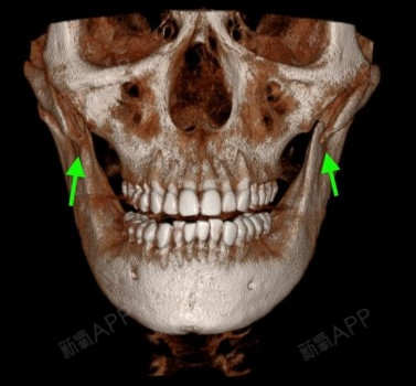 这是在我们医院做了颧骨修复的患者的ct