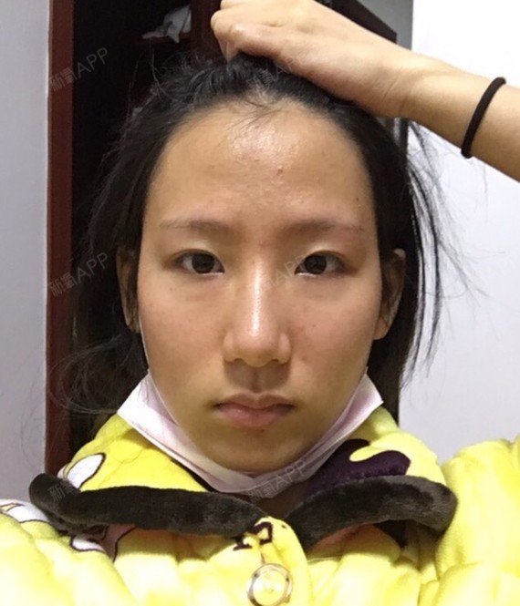 因为自己的脸颊十分消瘦,苹果肌和太阳穴也十分不饱满_圈子-新氧美容