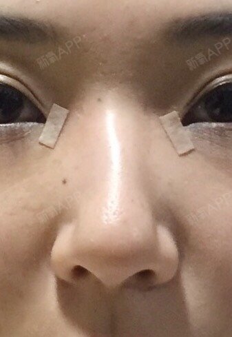 二月六号被忍后脑勺撞到鼻子右侧面,发现右面凹陷向左偏曲.