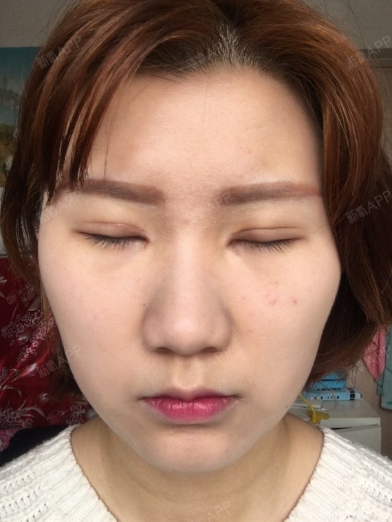 全切双眼皮,开眼角两个月了,左右明显不对称,左眼眼_圈子-新氧美容