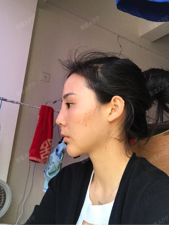 线雕鼻做两天鼻子肿的不行,我好怕他们说的线会扎出来