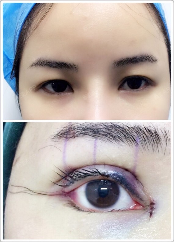 新氧- amybb1208 | 眼部 | 开眼角 | 双眼皮 | 开内眼角 | 开外眼角