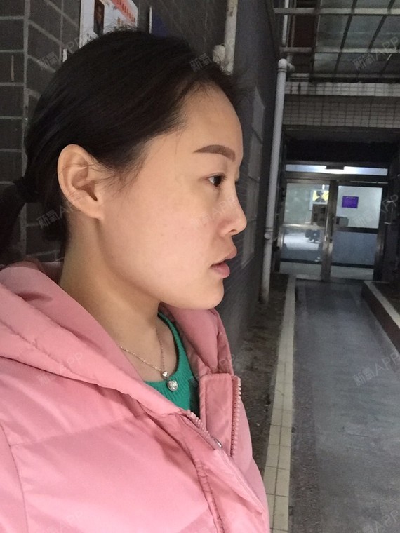 一直觉得自己脸很大很宽,而且有点月亮脸,感觉侧面很_圈子-新氧美容