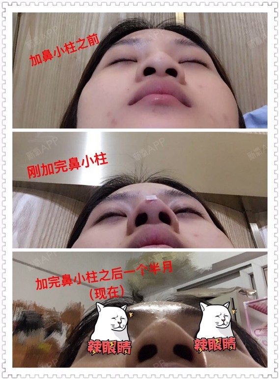 玻尿酸大鼻子会导致鼻子变宽的,后来才知道的教训.