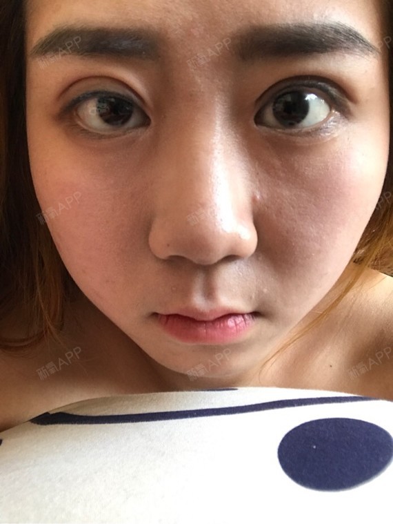 全切双眼皮一个月了左右眼睛明显不一祥  我每天都热敷  右眼刀口上方