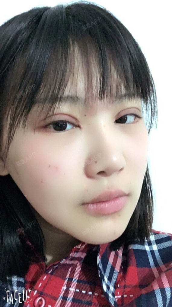 优しいyoyo开内眼角术后第30天美丽日记_新氧整形