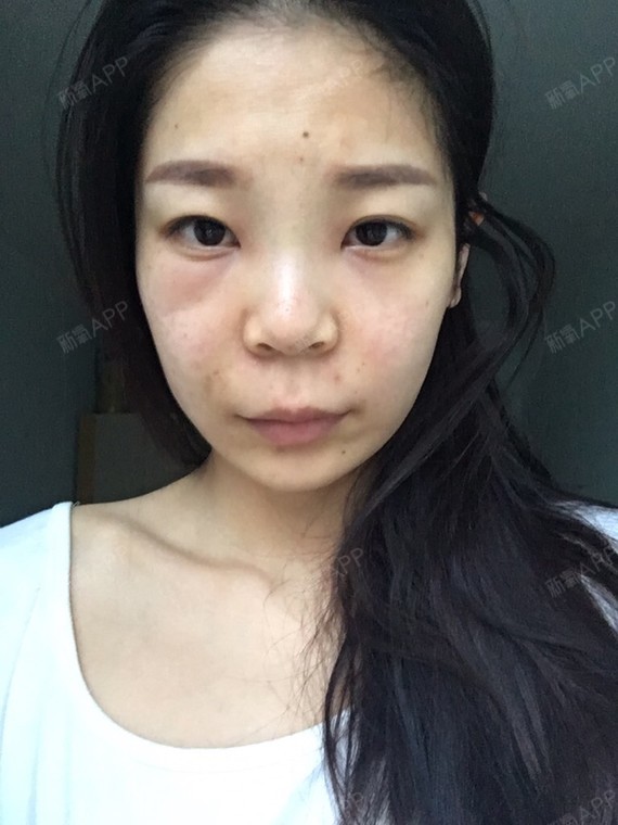 今天是第二天,仍然肿的跟猪头似的.