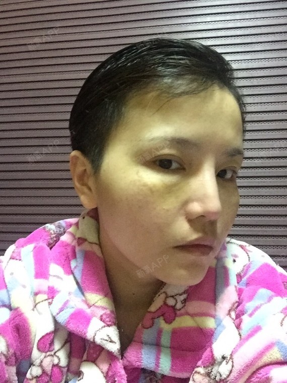 说说总体效果.现在还有_圈子-新氧美容整形