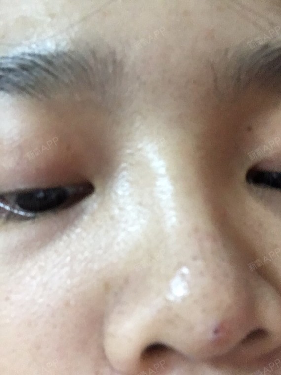 请问一下,我的鼻子三个月前做了线雕鼻,伤_圈子-新氧美容整形