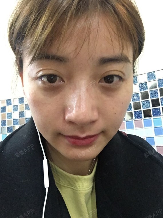 新氧- 小怪物的麻麻 | 眼部 | 术后当自强 | 国内整形 | 护肤 | 超声