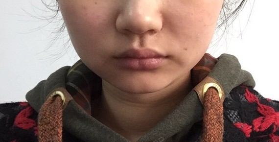 牙齿内倾深覆合以前还好最近吃东西的时候老_圈子-新氧美容整形