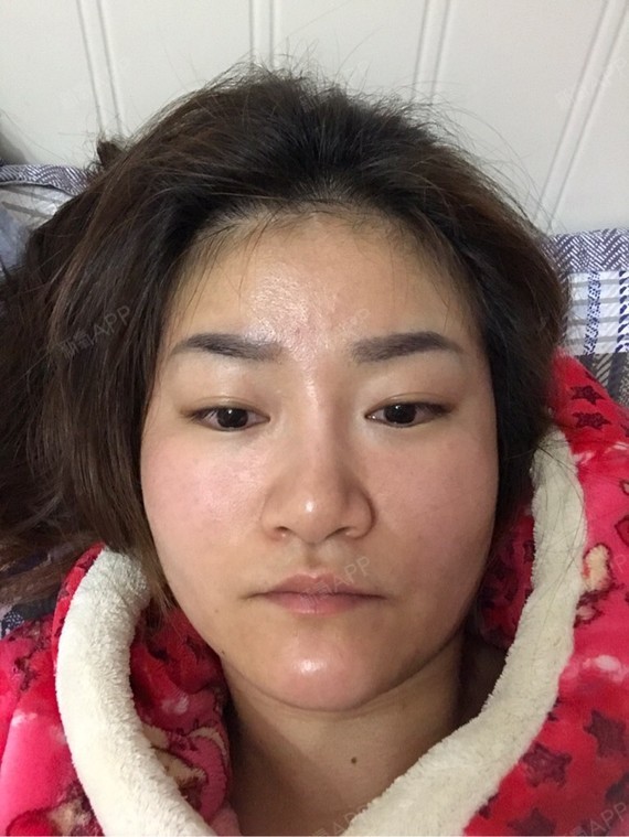 上海玻尿酸垫下巴好不好_效果图_tily小宝贝玻尿酸垫下巴术后第0天