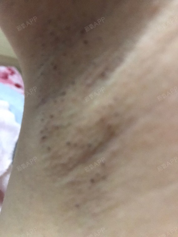 今天是第二天了,开始长出来露头了,就是现在一碰腋下_圈子-新氧美容