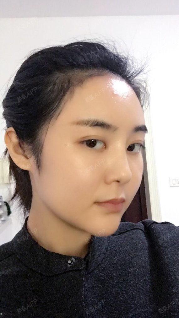 不好_效果图_氧气_bbjye1305自体脂肪丰额头术后第16天_新氧美容整形