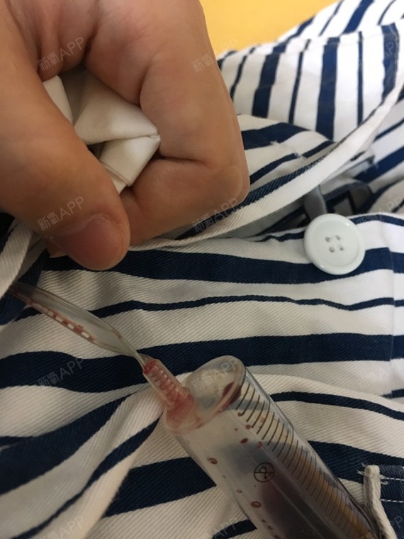 今天是手术后第六天,已经没有那么痛苦了!