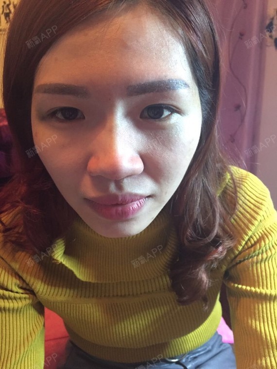 我做了线雕隆鼻.鼻背.