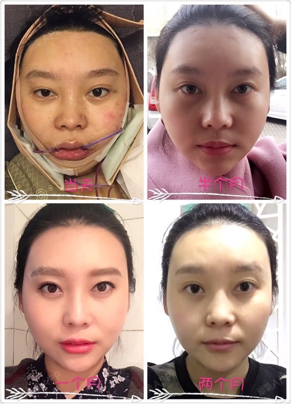 去关注大美丽kk颧骨内推第59天美丽日记