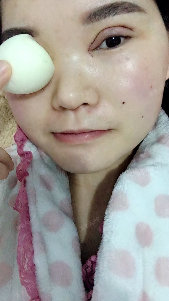 割双眼皮后可以用鸡蛋热敷吗？