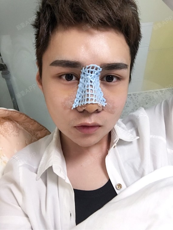 【韩国gng医院 轮廓三件套 术后304天】