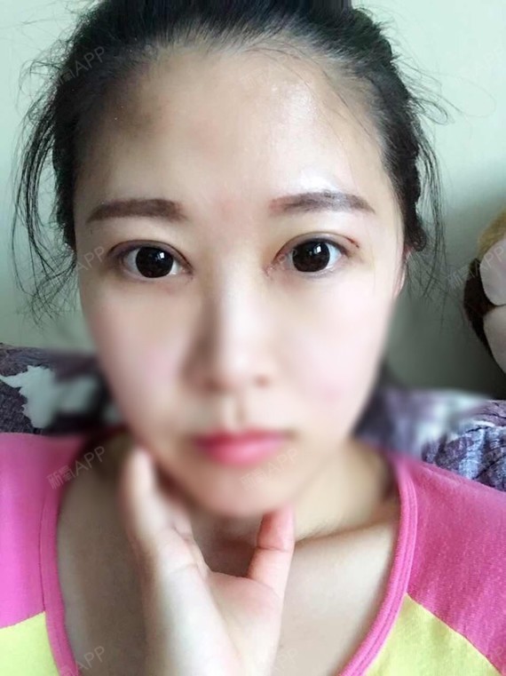 微切双眼皮 tringle开眼角第四天,真的太喜欢_圈子-新氧美容整形