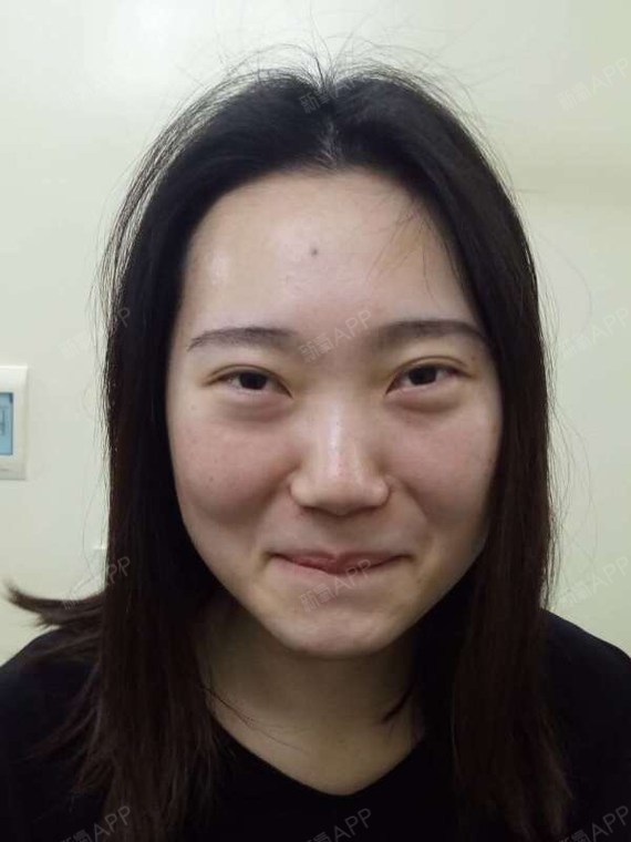 【武汉爱美汇内吸祛眼袋术后第0天】我是近几年才知道_圈子-新氧美容