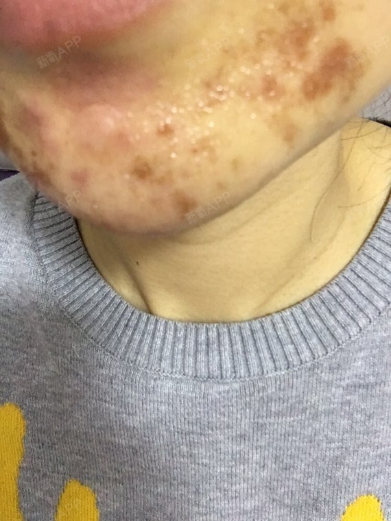 下巴刷了果酸,三天了,越来越严重,不是结痂,能好吗,有什么措施