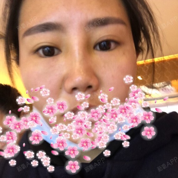 氧气xav25d1硅胶隆鼻第7天美丽日记