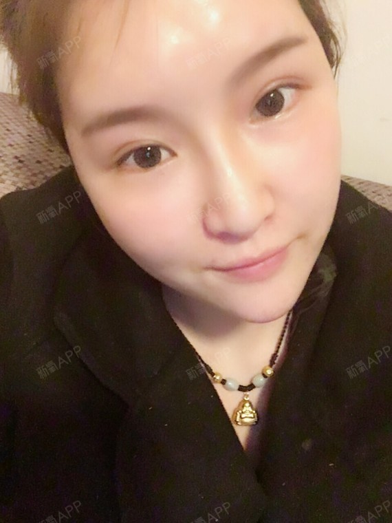 全脸填充手术轻度疼痛全脸填充医生查看刘湘个案例暂无评分鼻部整形