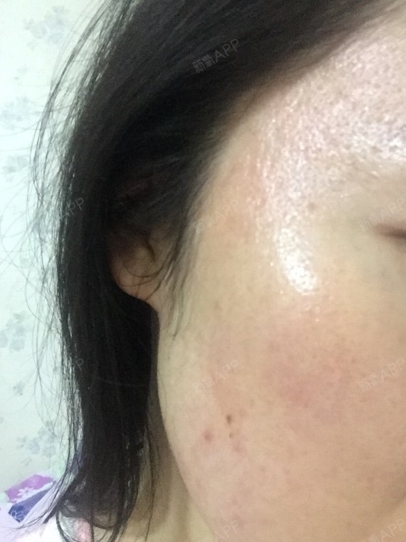 橘皮 大毛孔 黑头白头 整个人看上去老十岁 我要怎么办