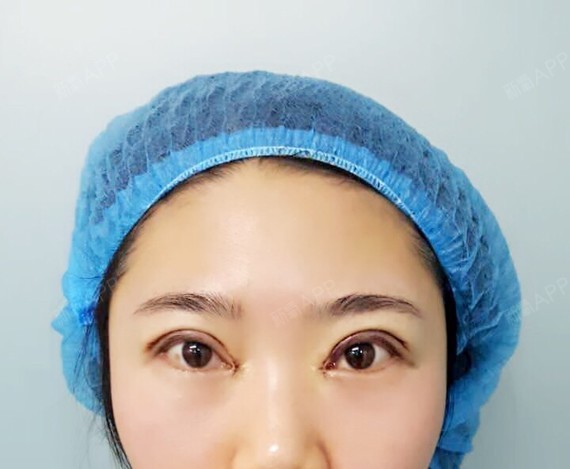 呵呵哈哈1001开内眼角第0天美丽日记