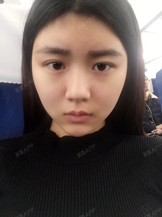 今天是第六天,瘦脸针已经开始见效了~记得原来打完没_圈子-新氧美容