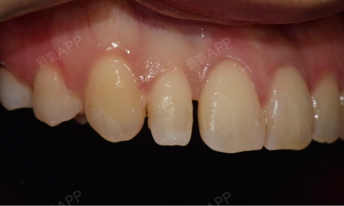 畸形的过小牙多好发于上颌侧切牙,临床表现多为牙齿形_圈子-新氧美容