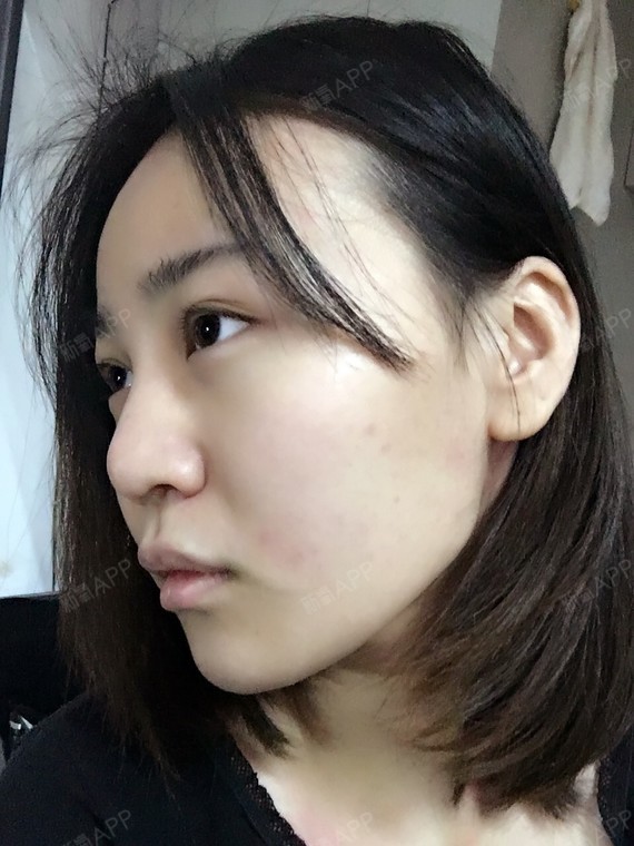 瘦脸针十五天的时候拍的照片感觉左边虽然多打了剂量但_圈子-新氧美容