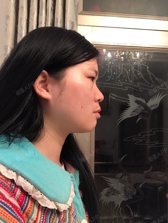 脸有点大额头两边凹陷,眼睛肿内双鼻子塌.