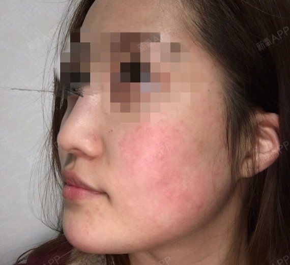 整形美容去红血丝（整形美容去红血丝有用吗） 整形美容去红血丝（整形美容去红血丝有效
吗）《整形医院去红血丝怎么样》 整形美容