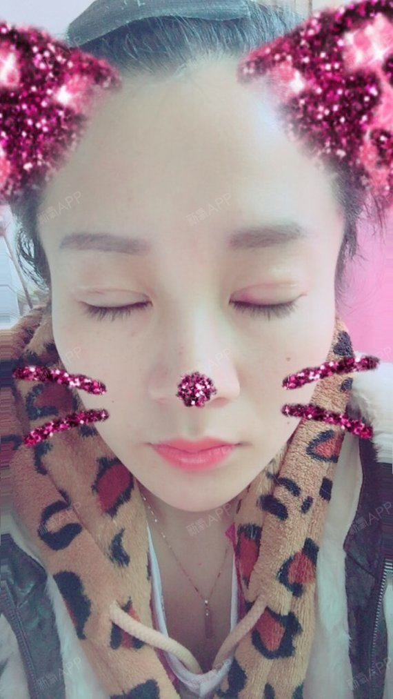 埋线双眼皮好不好_效果图_妖妖要变美埋线双眼皮术后第10天_新氧美容
