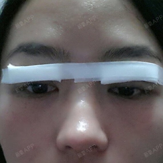 切开双眼皮