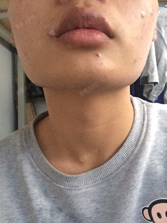 首先我是一名男性.从小下颌骨颧骨宽大,整个人就是_圈子-新氧美容整形