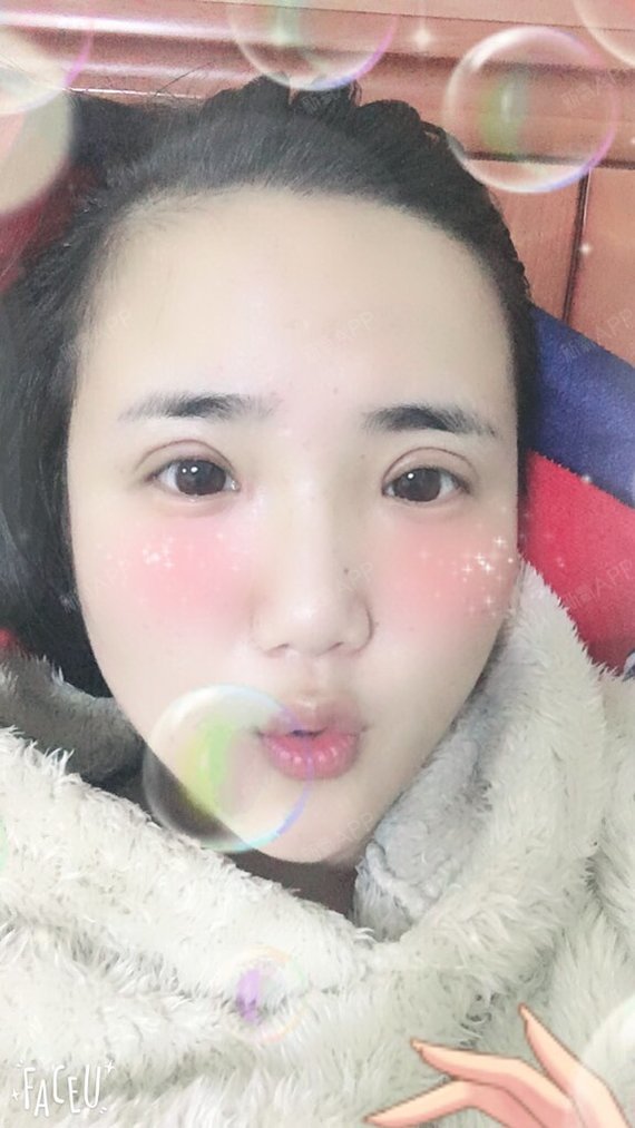 长沙切开双眼皮好不好_效果图_123456洋气切开双眼皮术后第14天_新氧